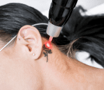 3 laser application