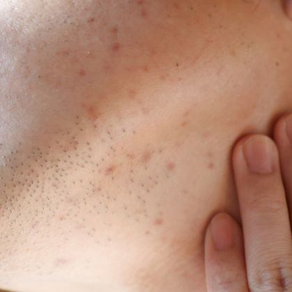 Acne Acne Scars