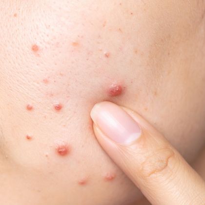 Acne & Breakouts