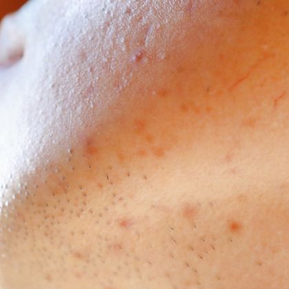Acne scars 1