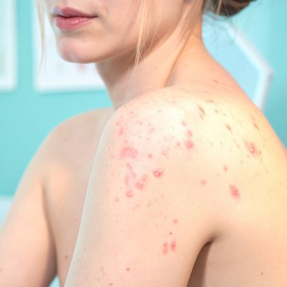Laser for Acne Scars treatment - MP Aesthetics Hub
