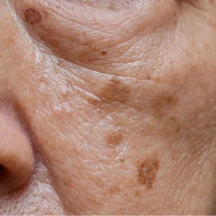 Age spots