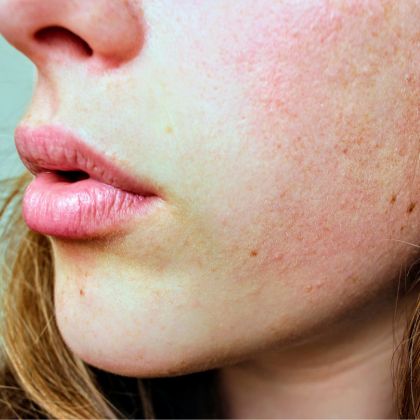 Clogged Pores