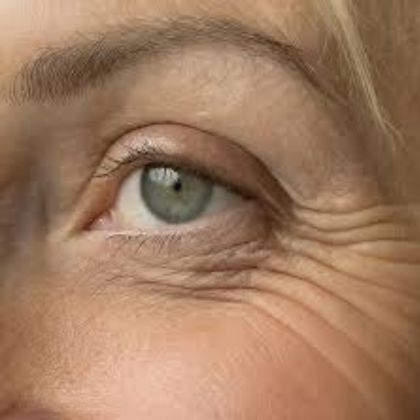 Crows feet