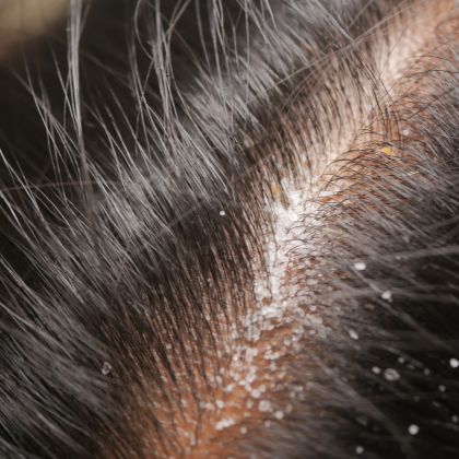 Dandruff flakes