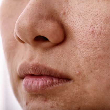 Dull Tired Skin 1