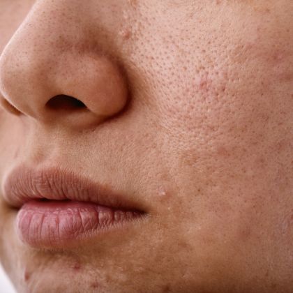 Dull aging skin