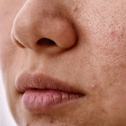 Dull and tired skin