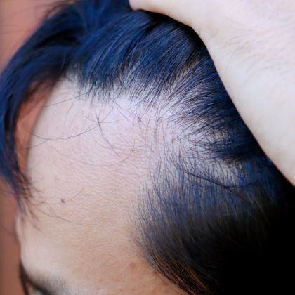 Early baldness