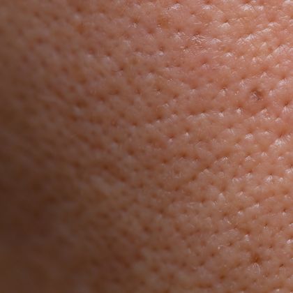 Enlarged Pores
