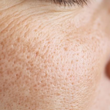 Enlarged pores