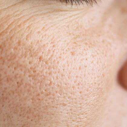 Laser for Acne Scars treatment - MP Aesthetics Hub