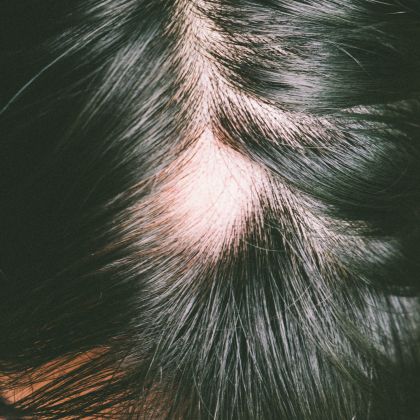 Excessive hair fall