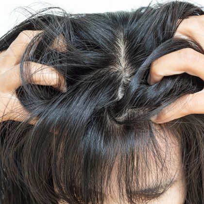 Itchy scalp