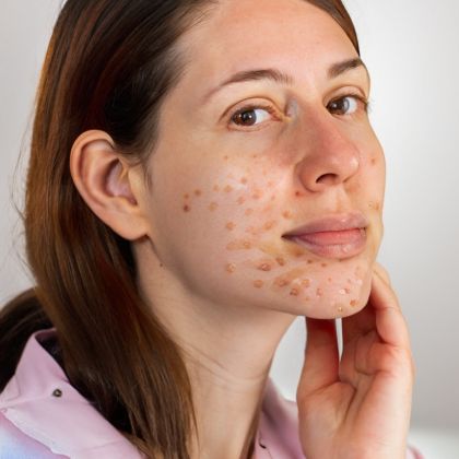 Mild Acne Marks
