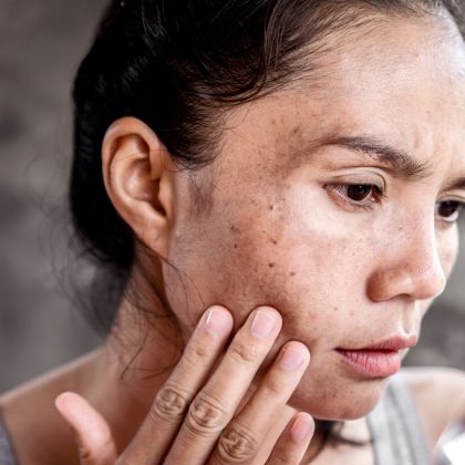 Mild pigmentation