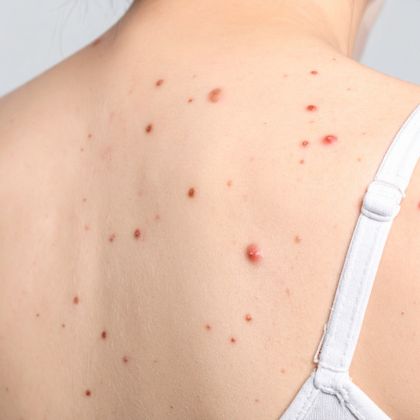 Moles