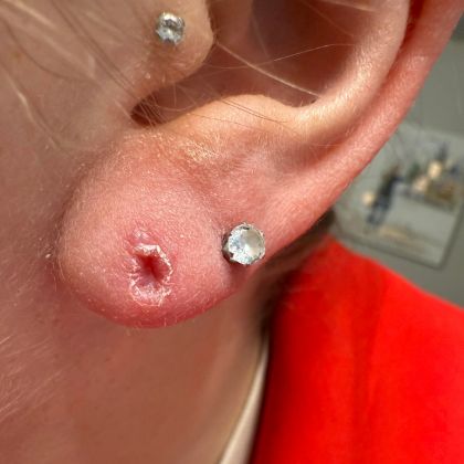 Old piercing damage