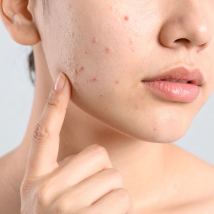 Laser for Acne Scars treatment - MP Aesthetics Hub