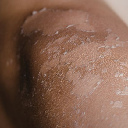 Laser for Acne Scars treatment - MP Aesthetics Hub