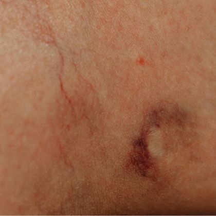 Skin damage marks