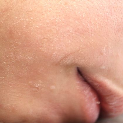 Skin tags