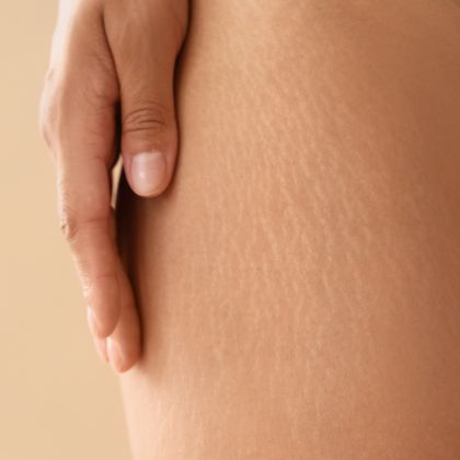 Stretch marks