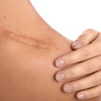 Surgical scars