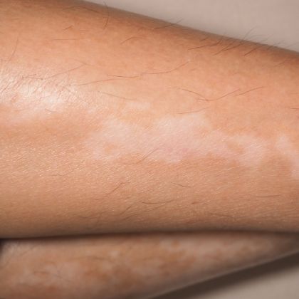 Uneven skin texture 2