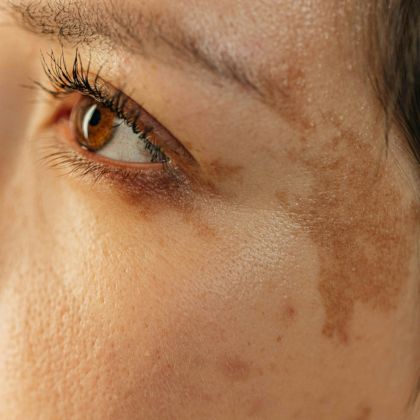 Uneven skin tone