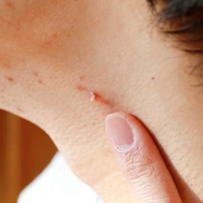 Warts