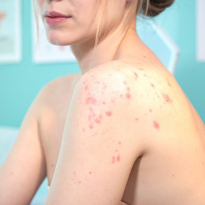acne acne marks 2