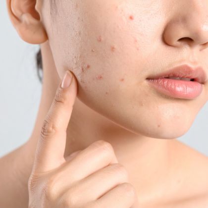 acne acne marks