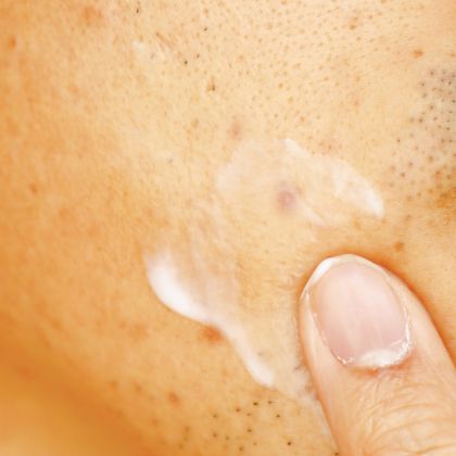 acne scars