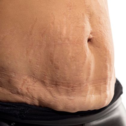 loss of skin firmness