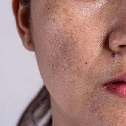 pigmentation dark sport