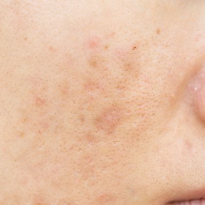 Laser for Pigmentation Treatment - MP Aesthetics Hub