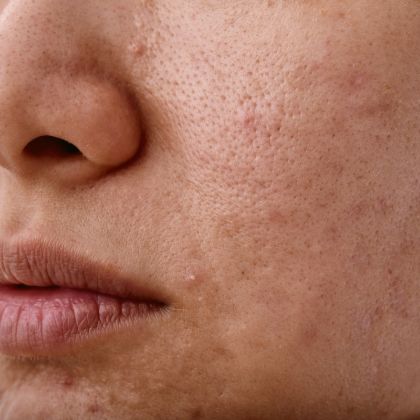 uneven skin pigmentation
