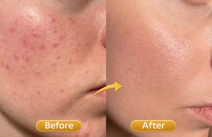 acne & pimple treatments in Sion West Mumbai