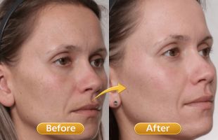 chemical peels