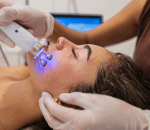 skin rejuvenation