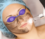 Laser activation